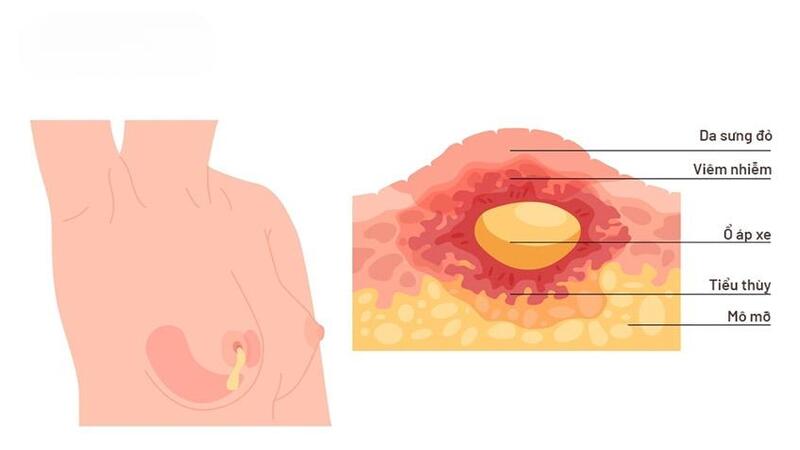 Áp xe do tắc tia sữa