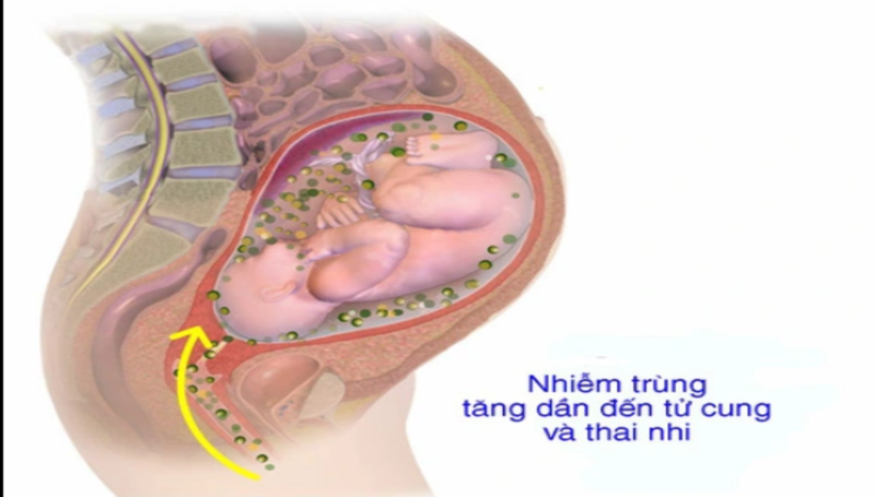 Bấm ối có nguy cơ nhiễm trùng bào thai