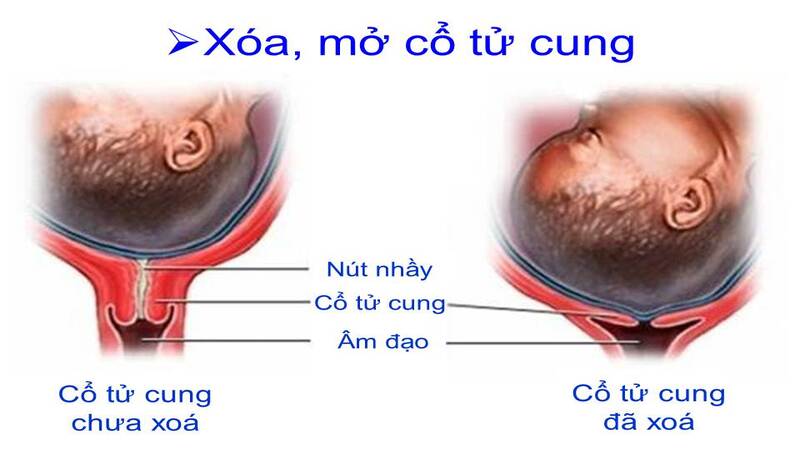 Bấm ối thực hiện khi cổ tử cung đã xóa mở