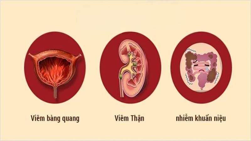 Hậu quả khi bí tiểu kéo dài quá lâu 