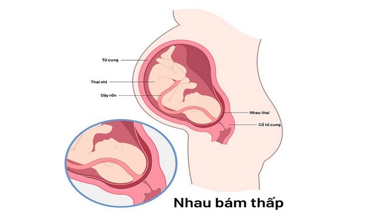 Thế nào là hiện tượng nhau bám thấp