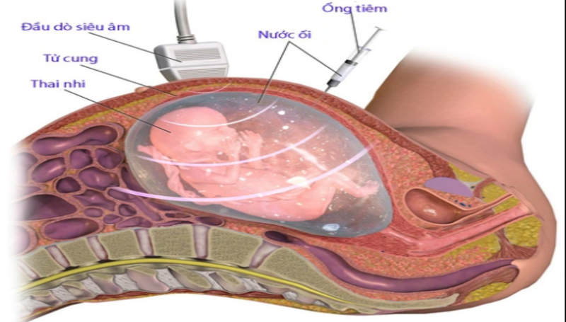 Siêu âm thai nhi và chỉ định bấm ối