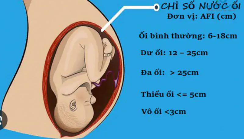 Chỉ số nước ối