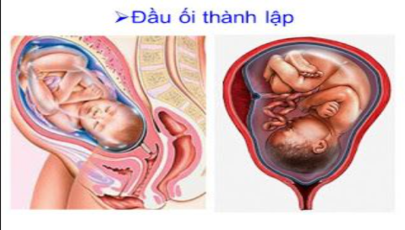 Bấm ối bao lâu thì sinh?