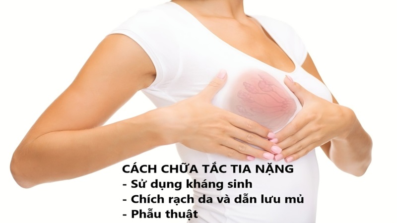 Cách chữa tắc tia sữa nặng