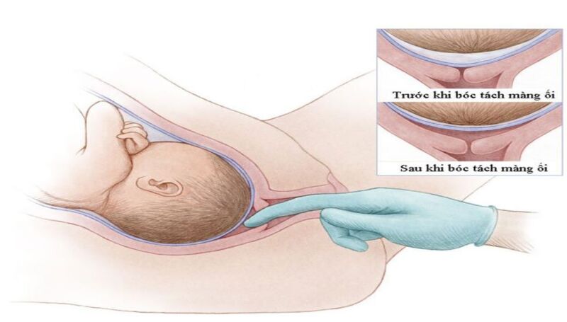 Kỹ thuật bóc tách màng ối khi bấm ối