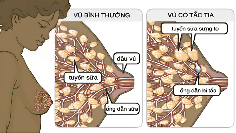 Nguyên nhân gây tắc tia sữa