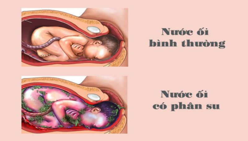 Nhận biết chỉ số nước ối bình thường