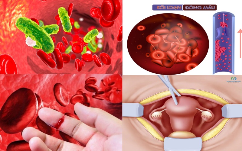 biến chứng nhiễm trùng khi tắc sản dịch