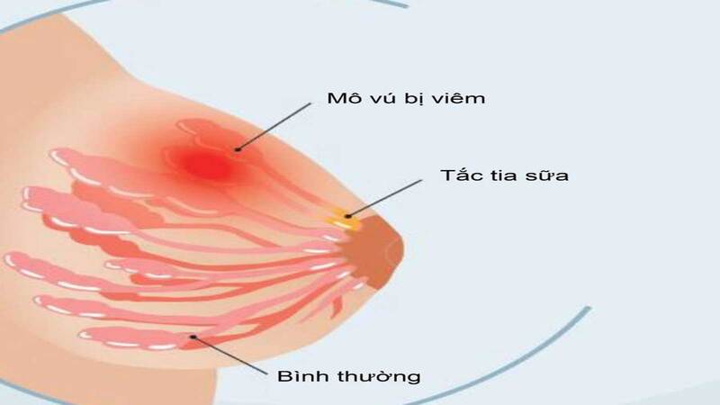 Tình trạng tắc tia sữa khi đang cho con bú