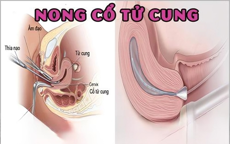 chữa bế tắc sản dịch bằng nong cổ tử cung