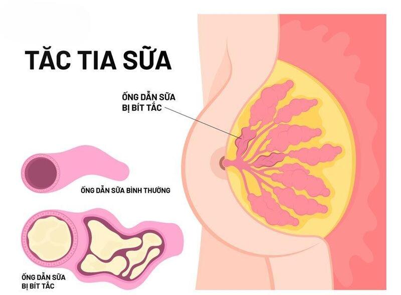 Tắc tia sữa khi đang cho con bú