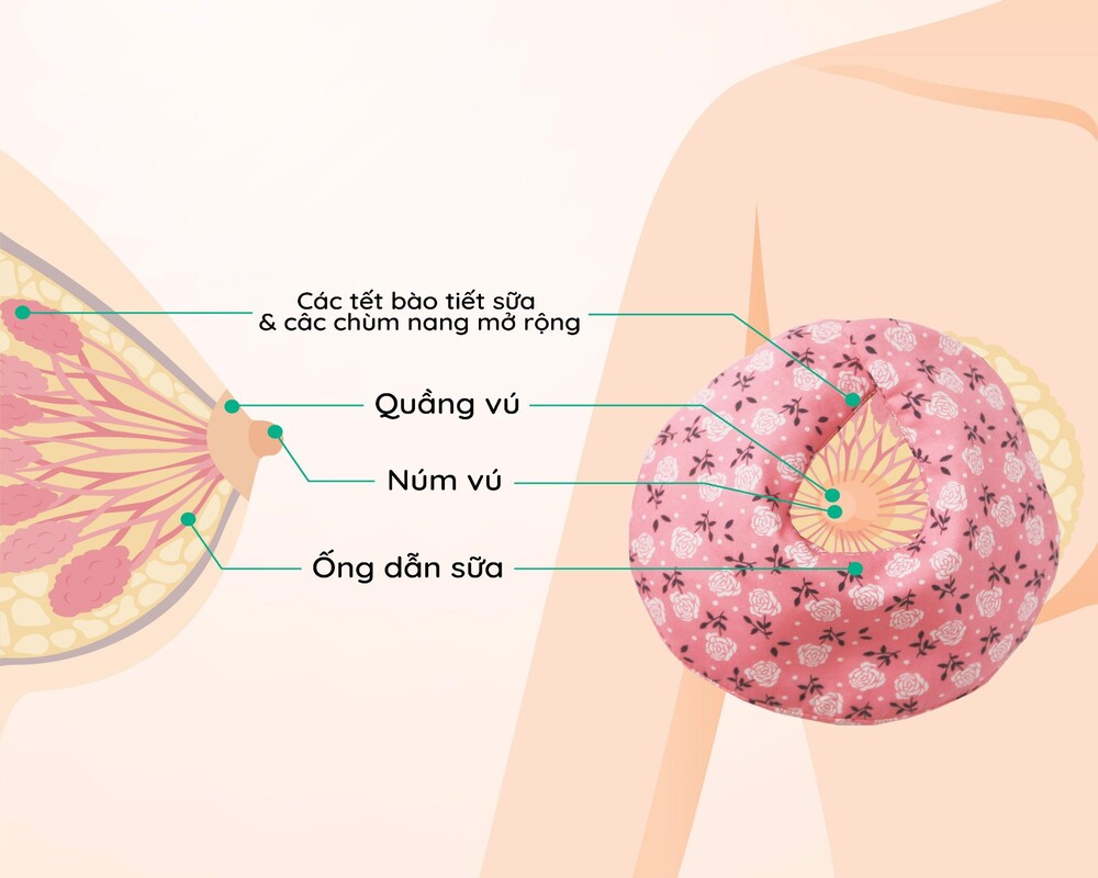 Tắc tia sữa nên làm gì