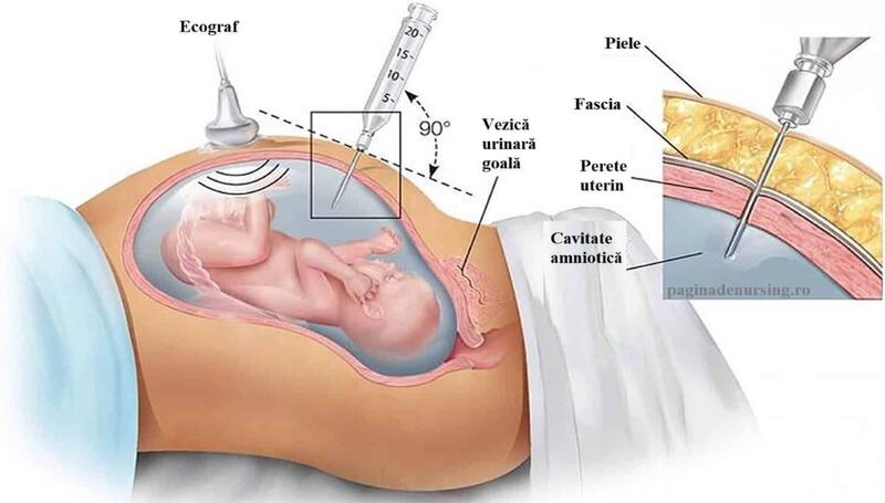 Một số lưu ý xác định ngôi thai khi bấm ối