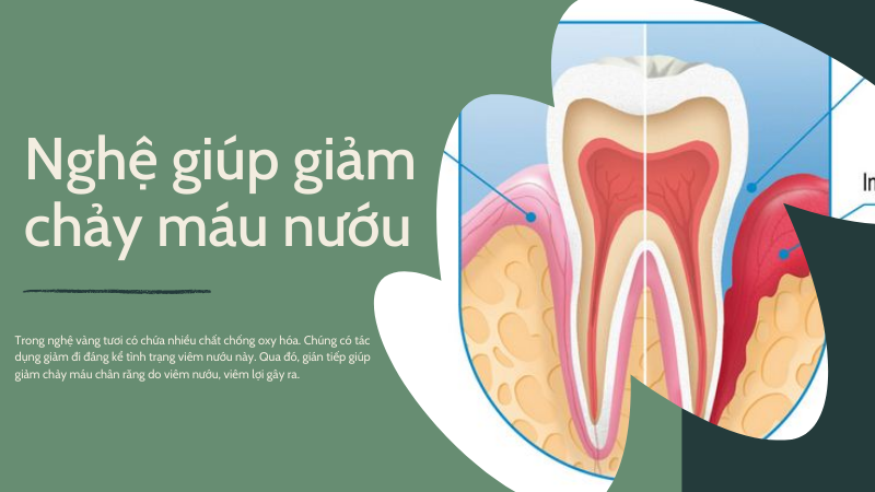 Nghệ giúp giảm chảy máu nướu